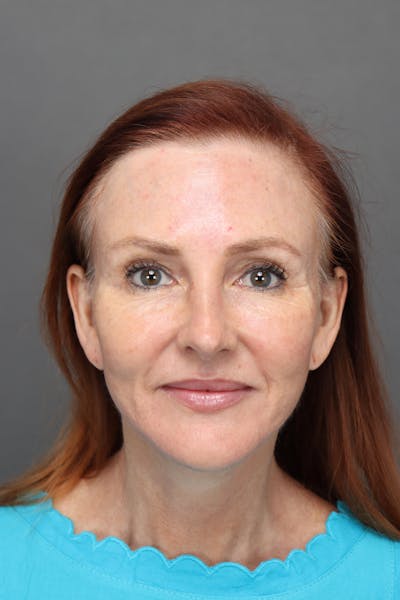 Weight Loss Facelift Before & After Gallery - Patient 251189 - Image 2