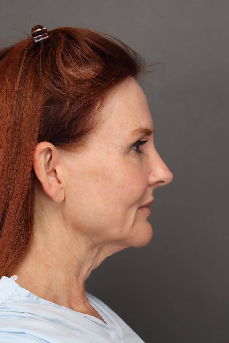 Weight Loss Facelift Before & After Gallery - Patient 251189 - Image 3