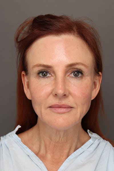 Weight Loss Facelift Before & After Gallery - Patient 251189 - Image 1