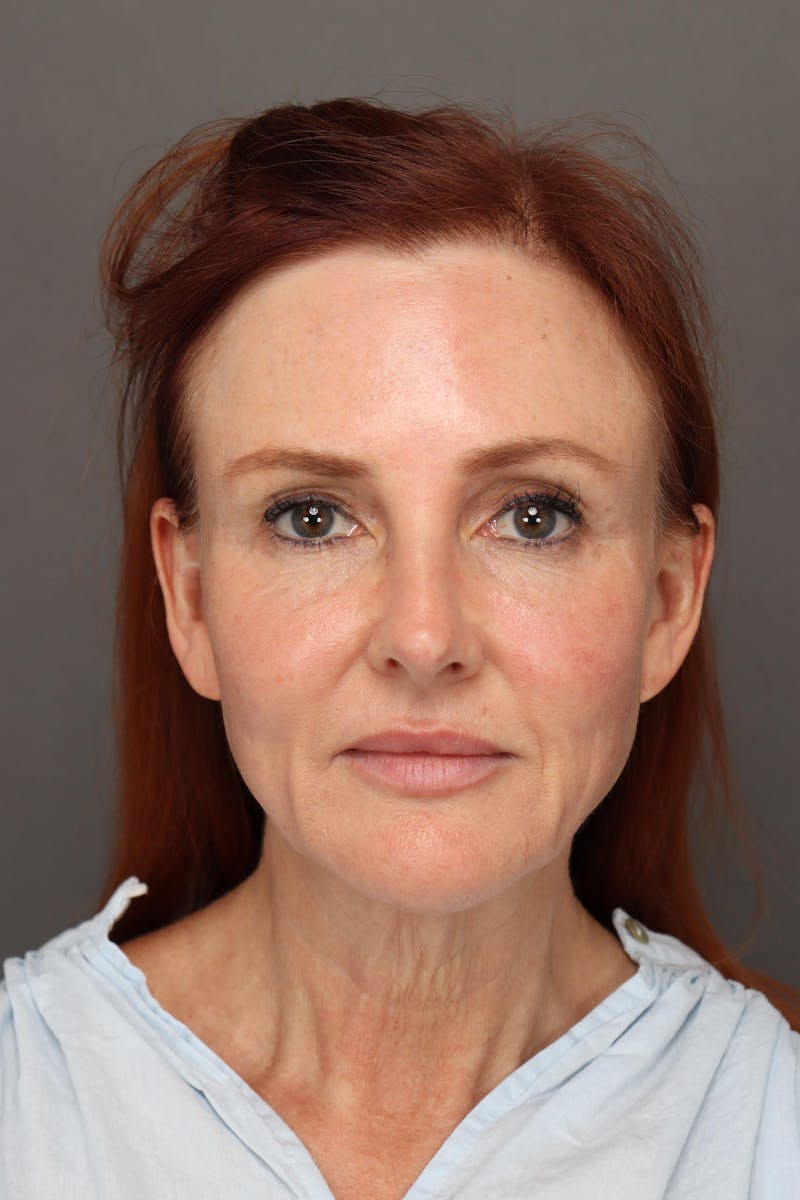 Weight Loss Facelift Before & After Gallery - Patient 251189 - Image 1
