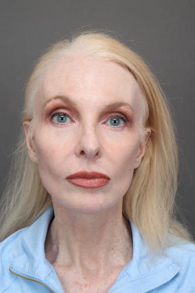 Weight Loss Facelift Before & After Gallery - Patient 144089 - Image 2