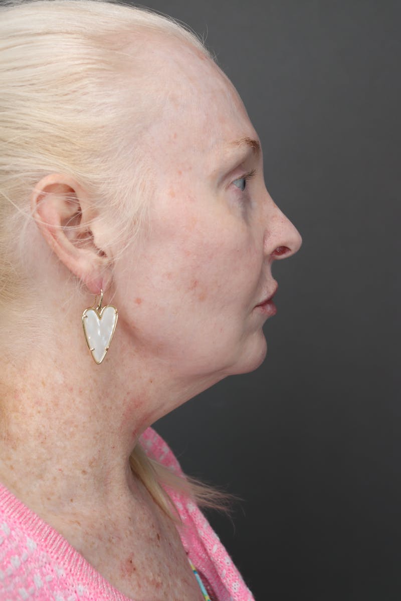 Weight Loss Facelift Before & After Gallery - Patient 144089 - Image 3