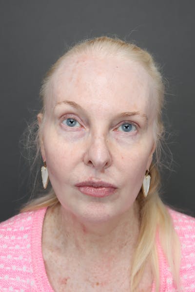 Weight Loss Facelift Before & After Gallery - Patient 144089 - Image 1