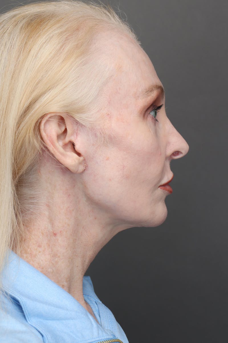 Weight Loss Facelift Before & After Gallery - Patient 144089 - Image 4