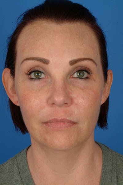 Weight Loss Facelift Before & After Gallery - Patient 273833 - Image 1