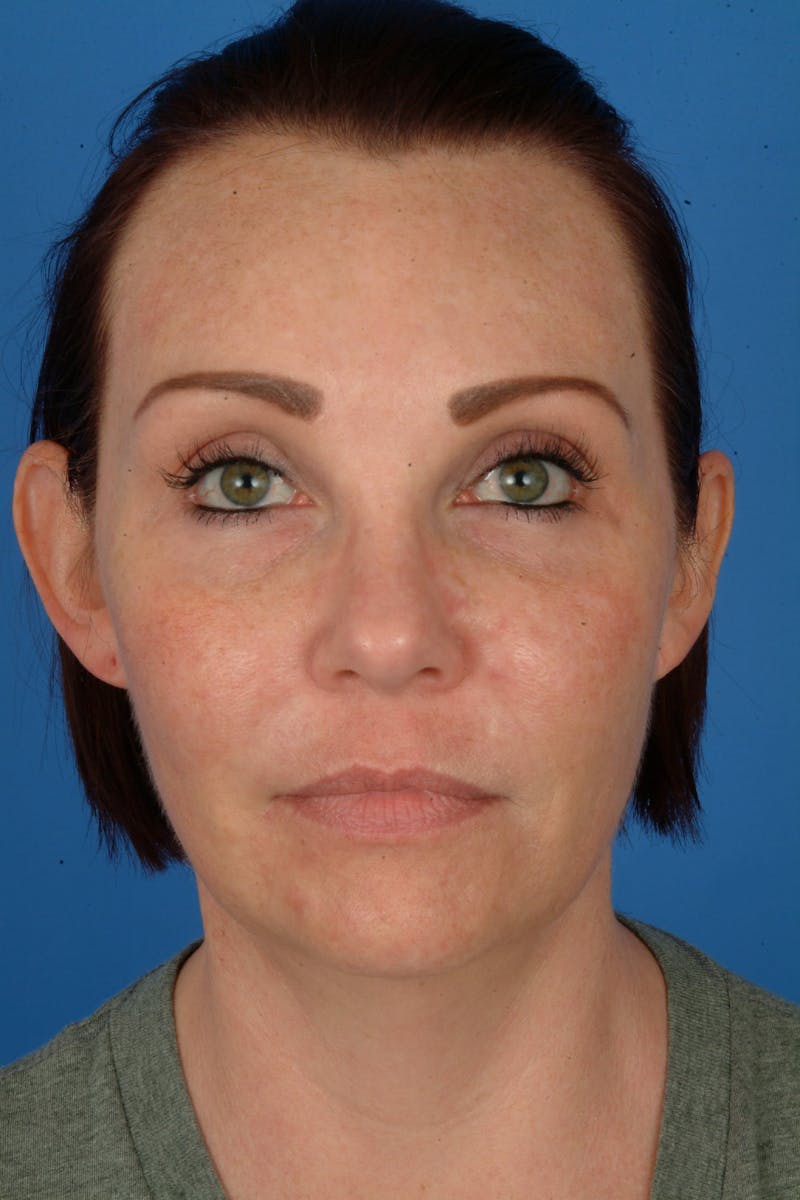 Weight Loss Facelift Before & After Gallery - Patient 273833 - Image 1