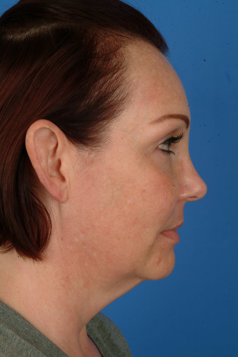 Weight Loss Facelift Before & After Gallery - Patient 273833 - Image 3