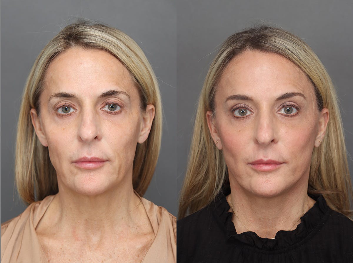 Facelifts Before & After Gallery - Patient 179561 - Image 1