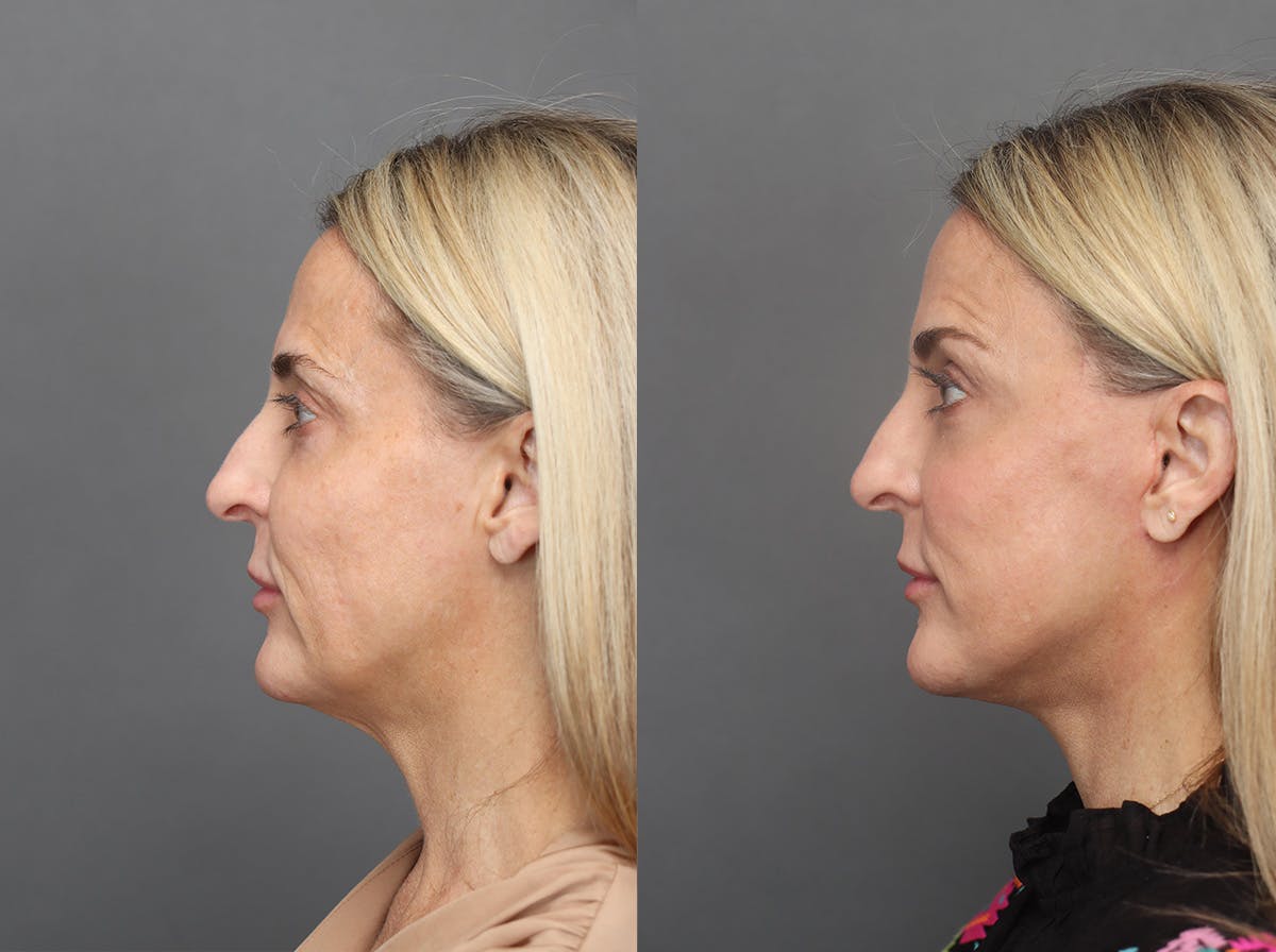 Facelifts Before & After Gallery - Patient 179561 - Image 2