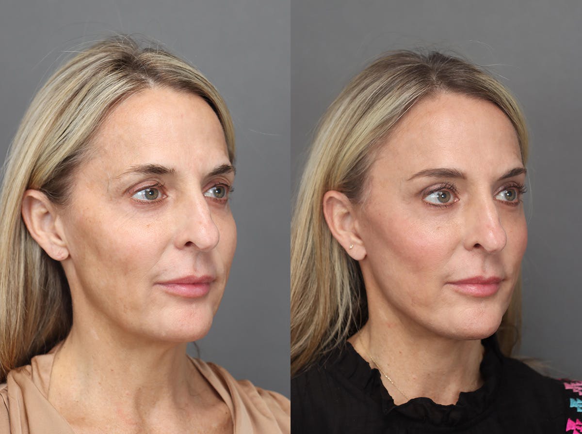 Facelifts Before & After Gallery - Patient 179561 - Image 4