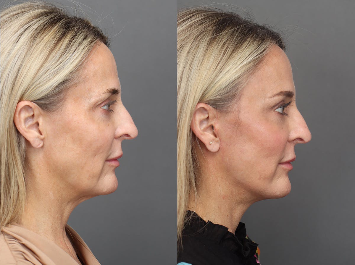 Facelifts Before & After Gallery - Patient 179561 - Image 5