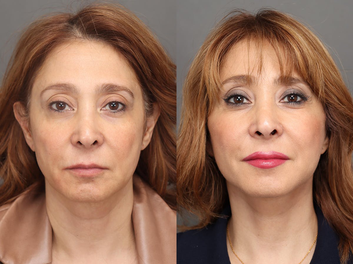 Facelifts Before & After Gallery - Patient 713755 - Image 1