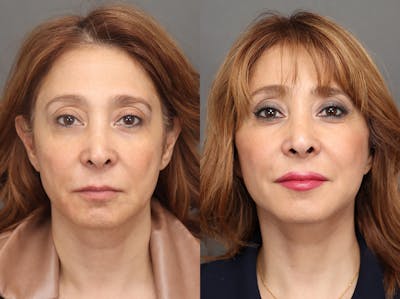 Facelifts Before & After Gallery - Patient 713755 - Image 1
