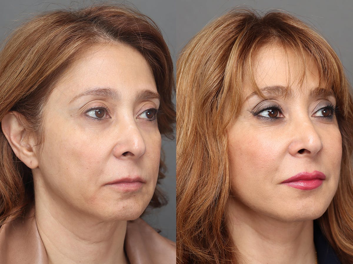 Facelifts Before & After Gallery - Patient 713755 - Image 2
