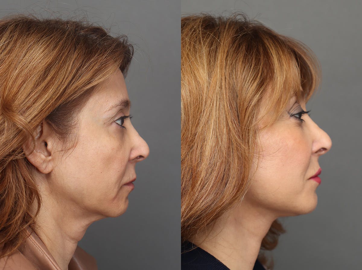 Facelifts Before & After Gallery - Patient 713755 - Image 3