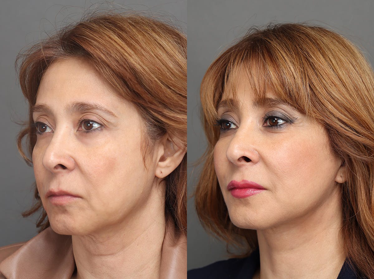 Facelifts Before & After Gallery - Patient 713755 - Image 4