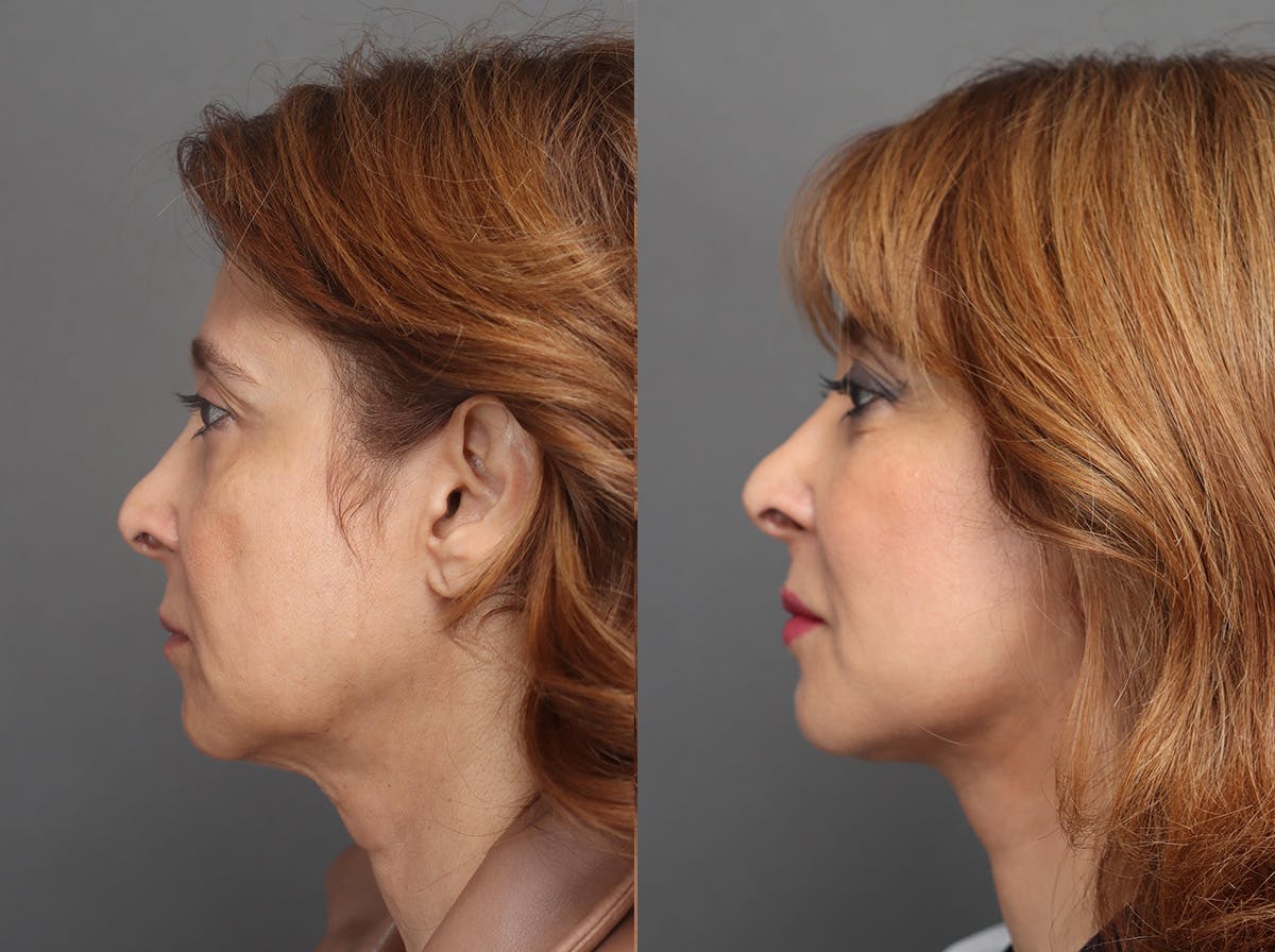 Facelifts Before & After Gallery - Patient 713755 - Image 5