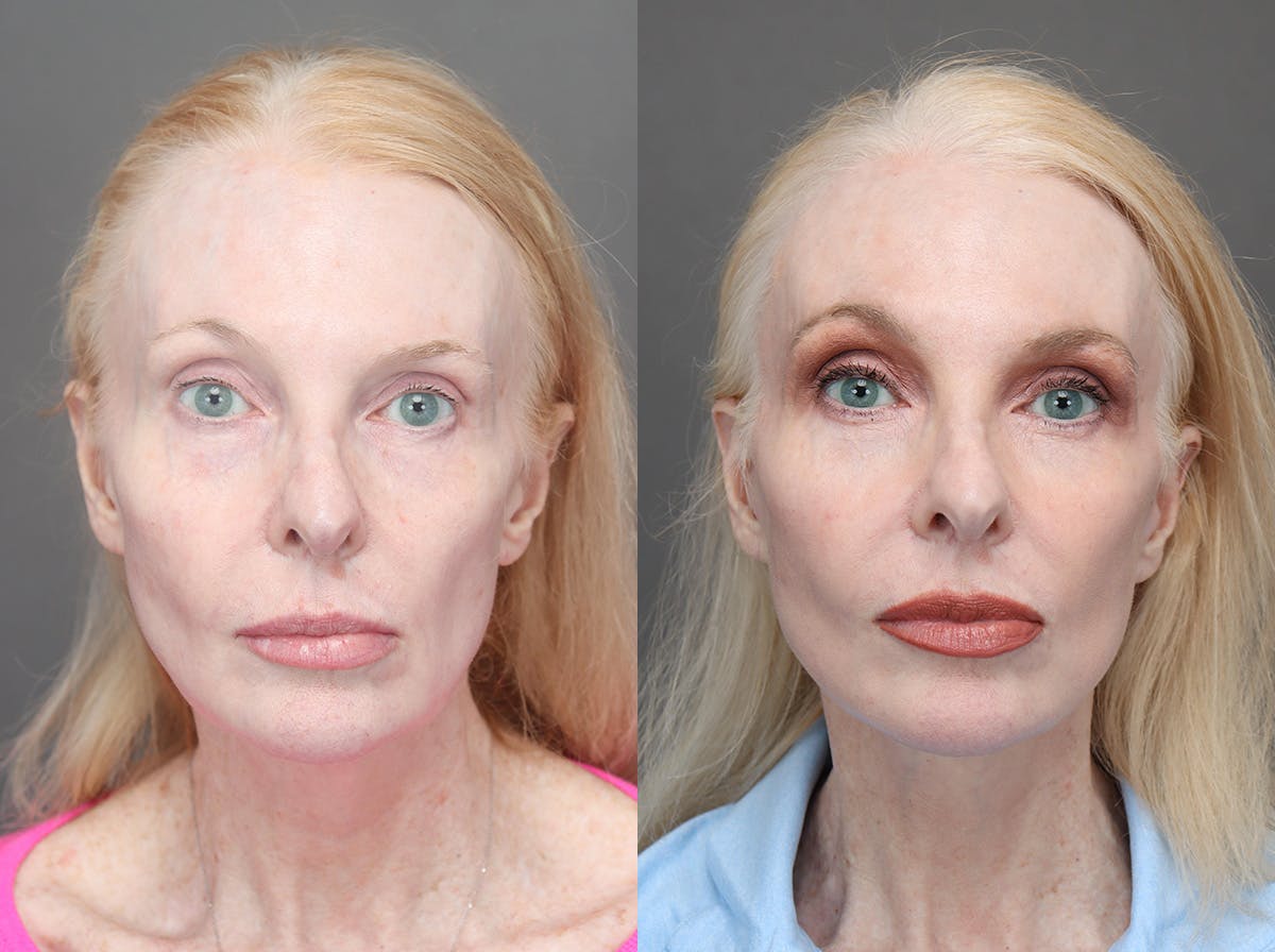 Facelifts Before & After Gallery - Patient 340034 - Image 1
