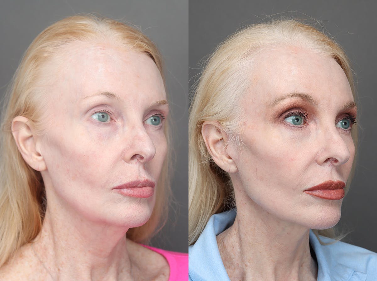 Facelifts Before & After Gallery - Patient 340034 - Image 2
