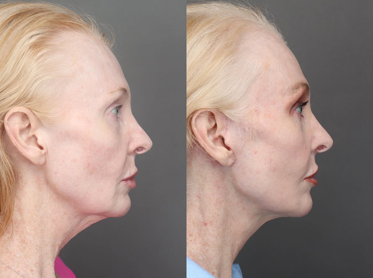 Facelifts Before & After Gallery - Patient 340034 - Image 3
