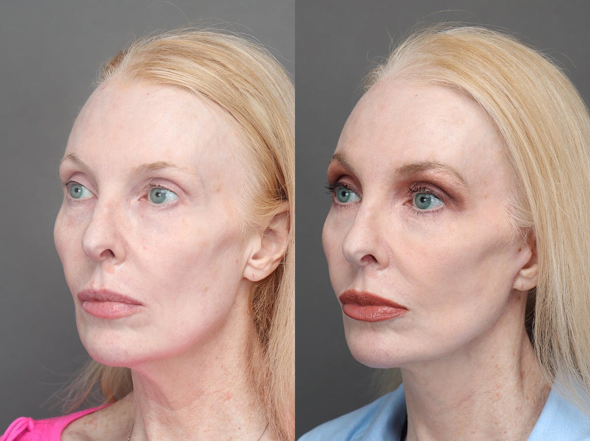 Facelifts Before & After Gallery - Patient 340034 - Image 4