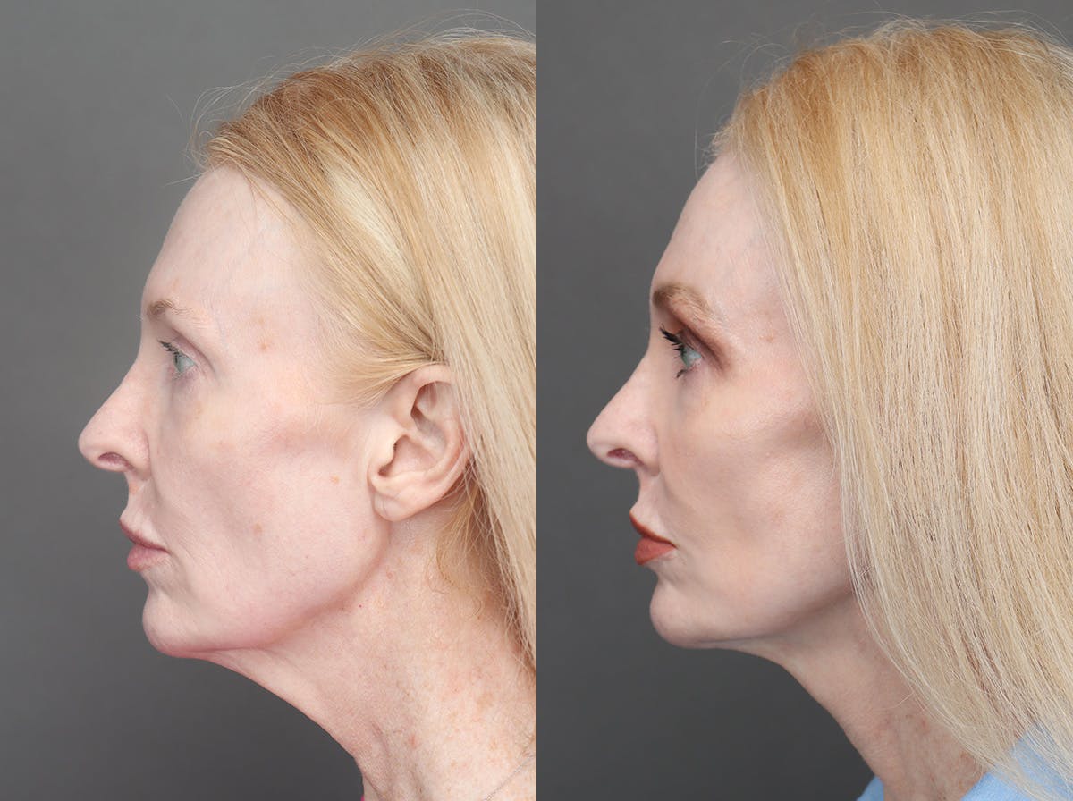 Facelifts Before & After Gallery - Patient 340034 - Image 5