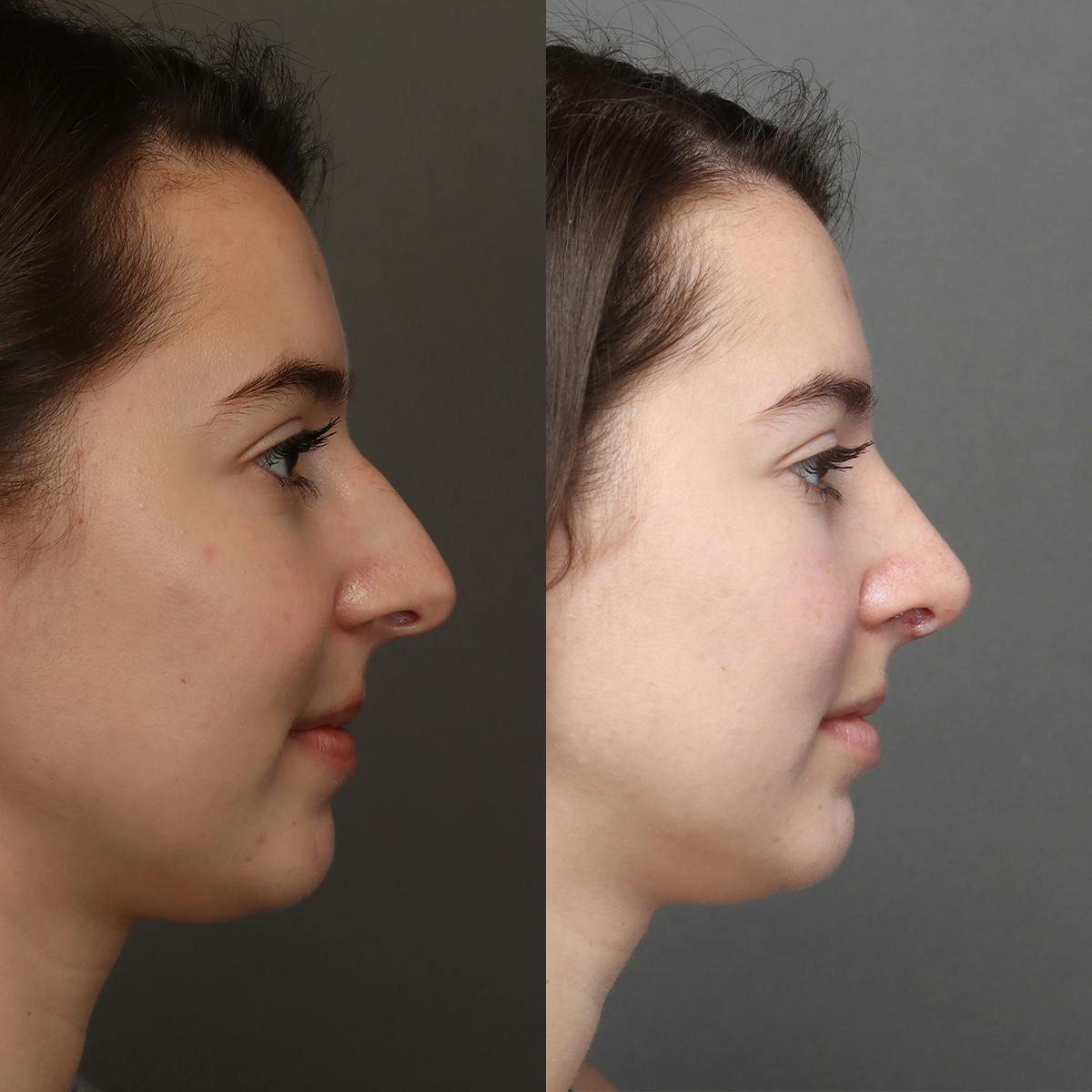 Rhinoplasty Before & After Gallery - Patient 260218 - Image 1