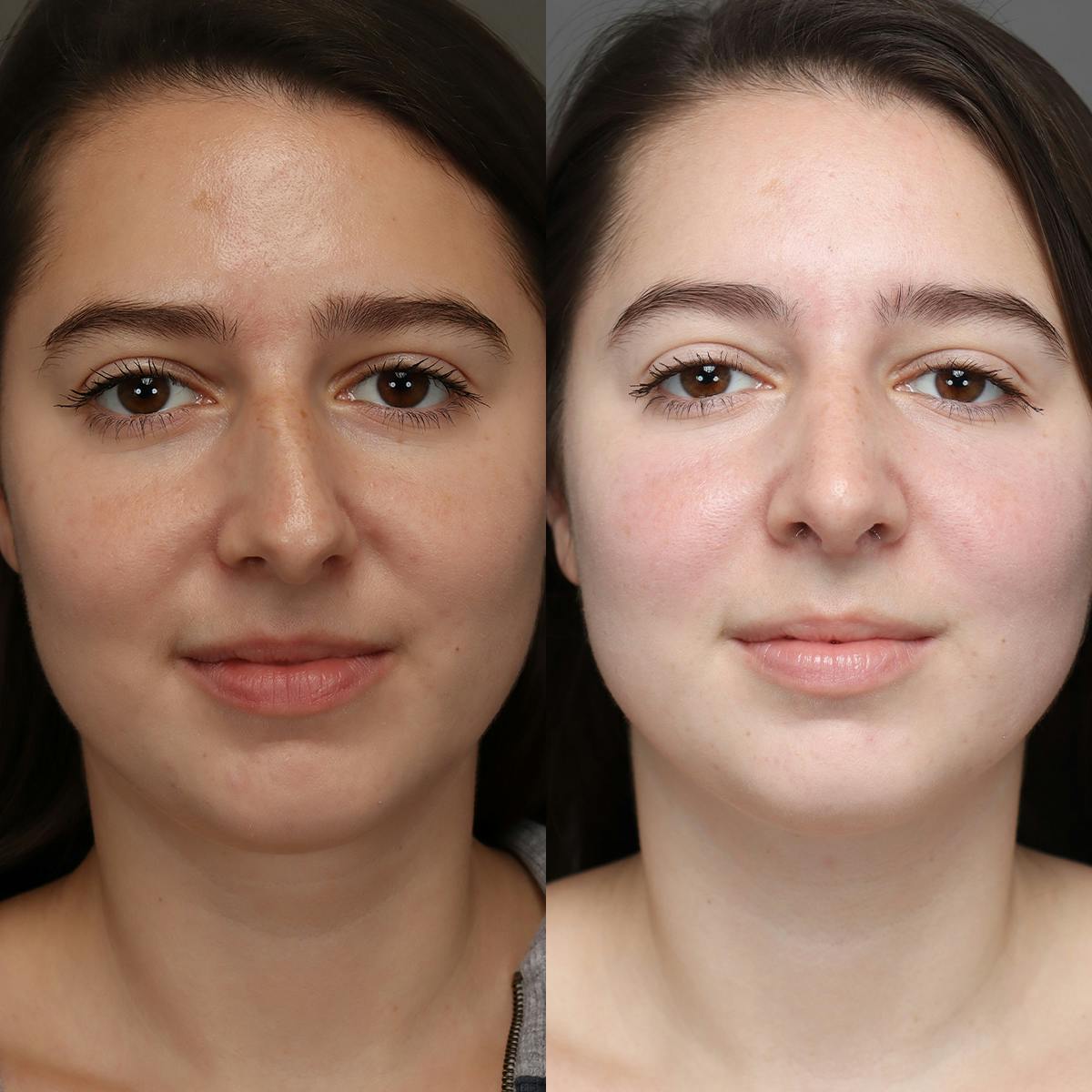 Rhinoplasty Before & After Gallery - Patient 260218 - Image 2