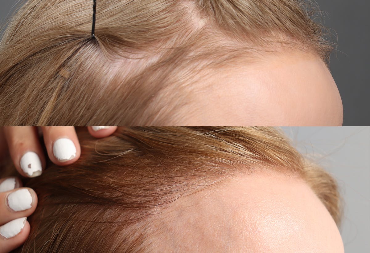 Hair Restoration Before & After Gallery - Patient 102232 - Image 2