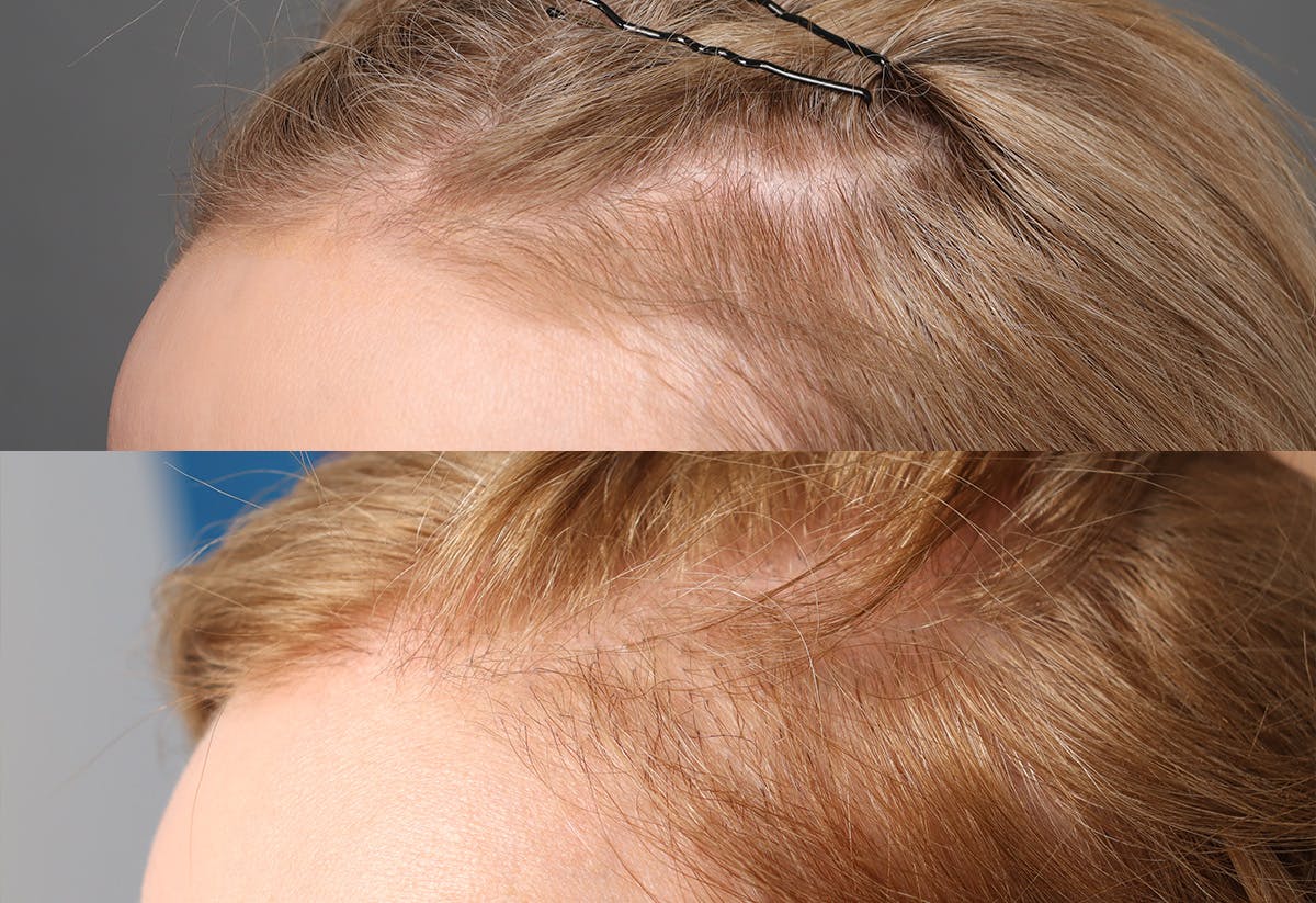 Hair Restoration Before & After Gallery - Patient 102232 - Image 3