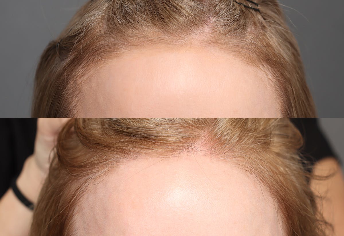 Hair Restoration Before & After Gallery - Patient 102232 - Image 1
