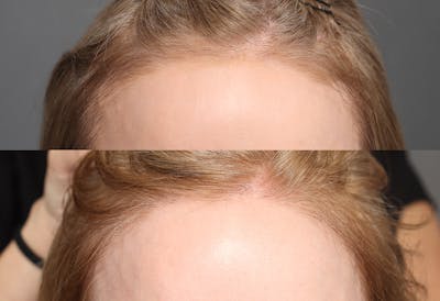 Hair Restoration Before & After Gallery - Patient 102232 - Image 1