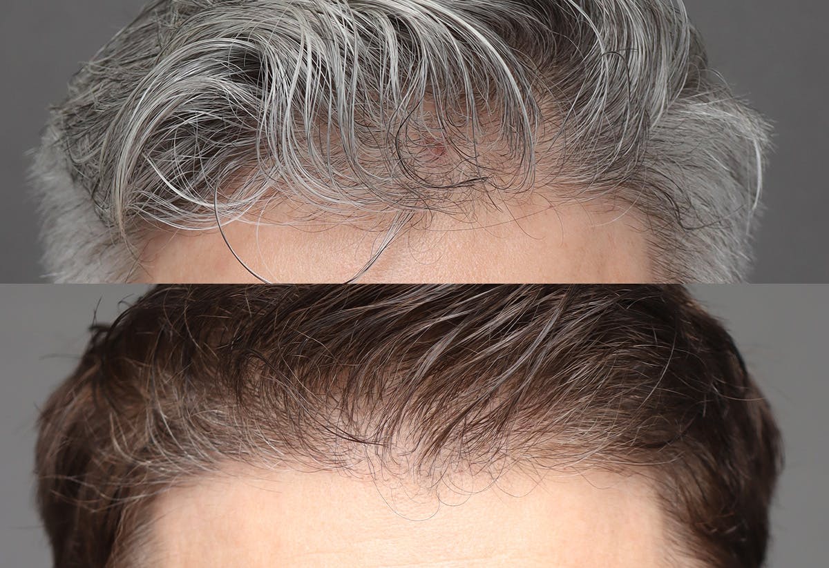 Hair Restoration Before & After Gallery - Patient 406509 - Image 1