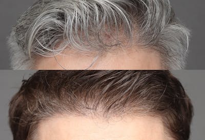 Hair Restoration Before & After Gallery - Patient 406509 - Image 1
