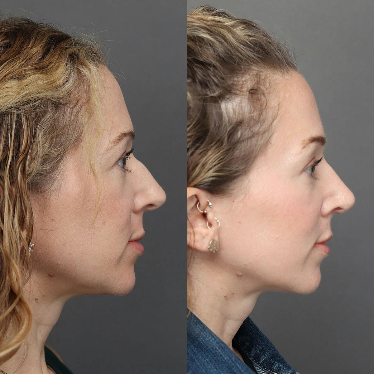 Rhinoplasty Before & After Gallery - Patient 322343 - Image 1
