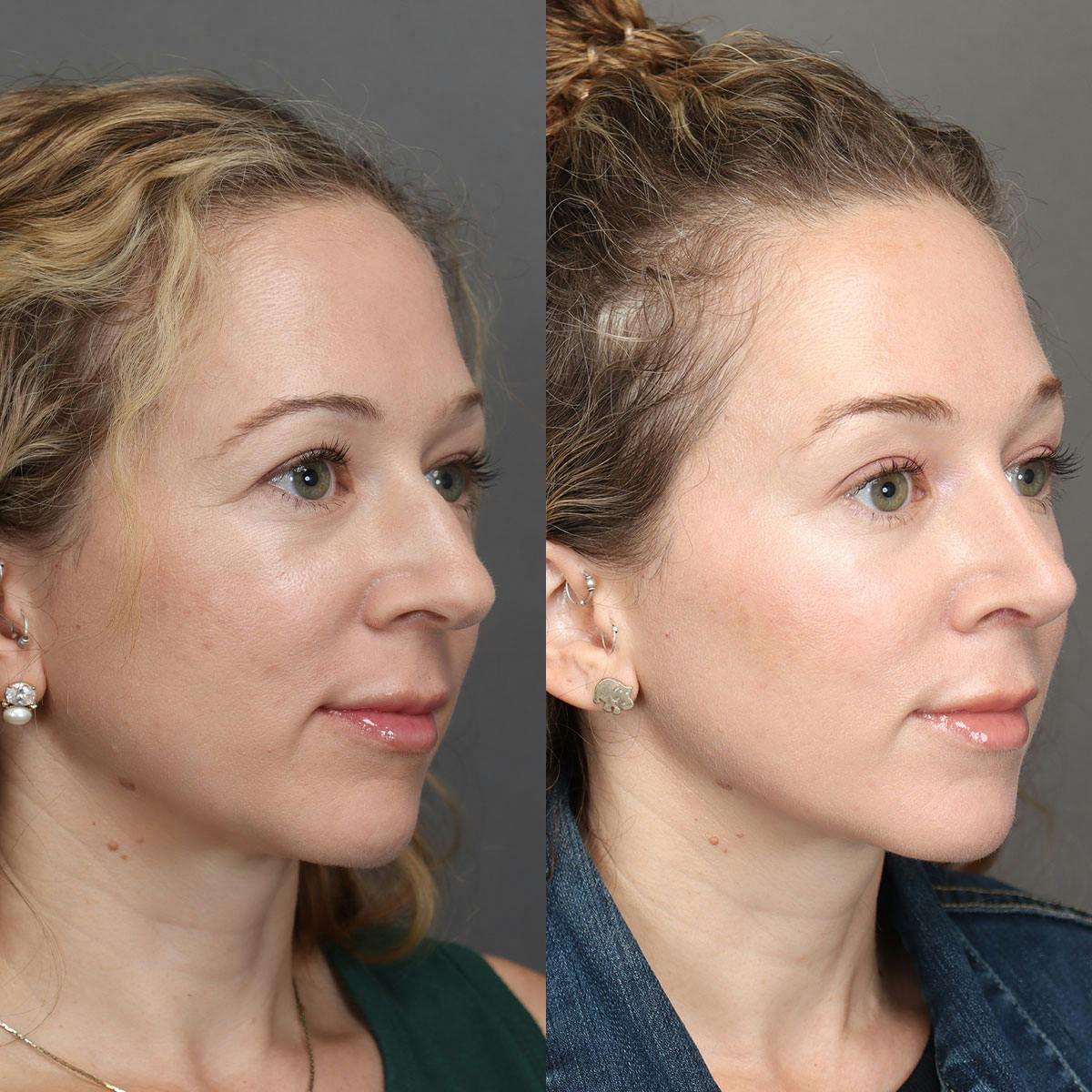 Rhinoplasty Before & After Gallery - Patient 322343 - Image 2