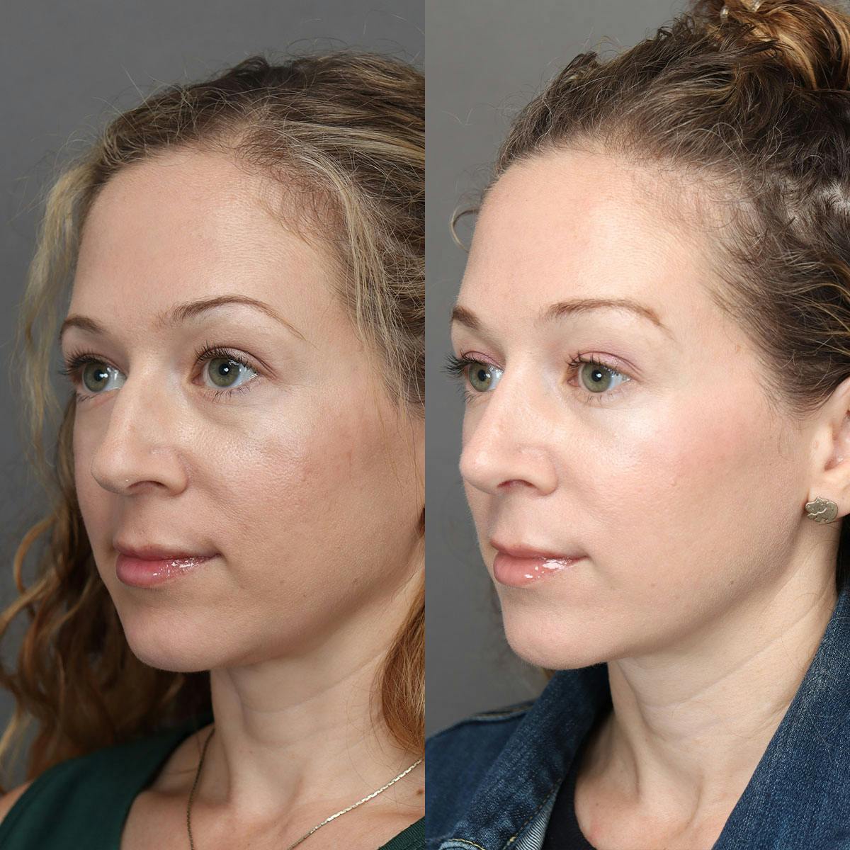 Rhinoplasty Before & After Gallery - Patient 322343 - Image 4