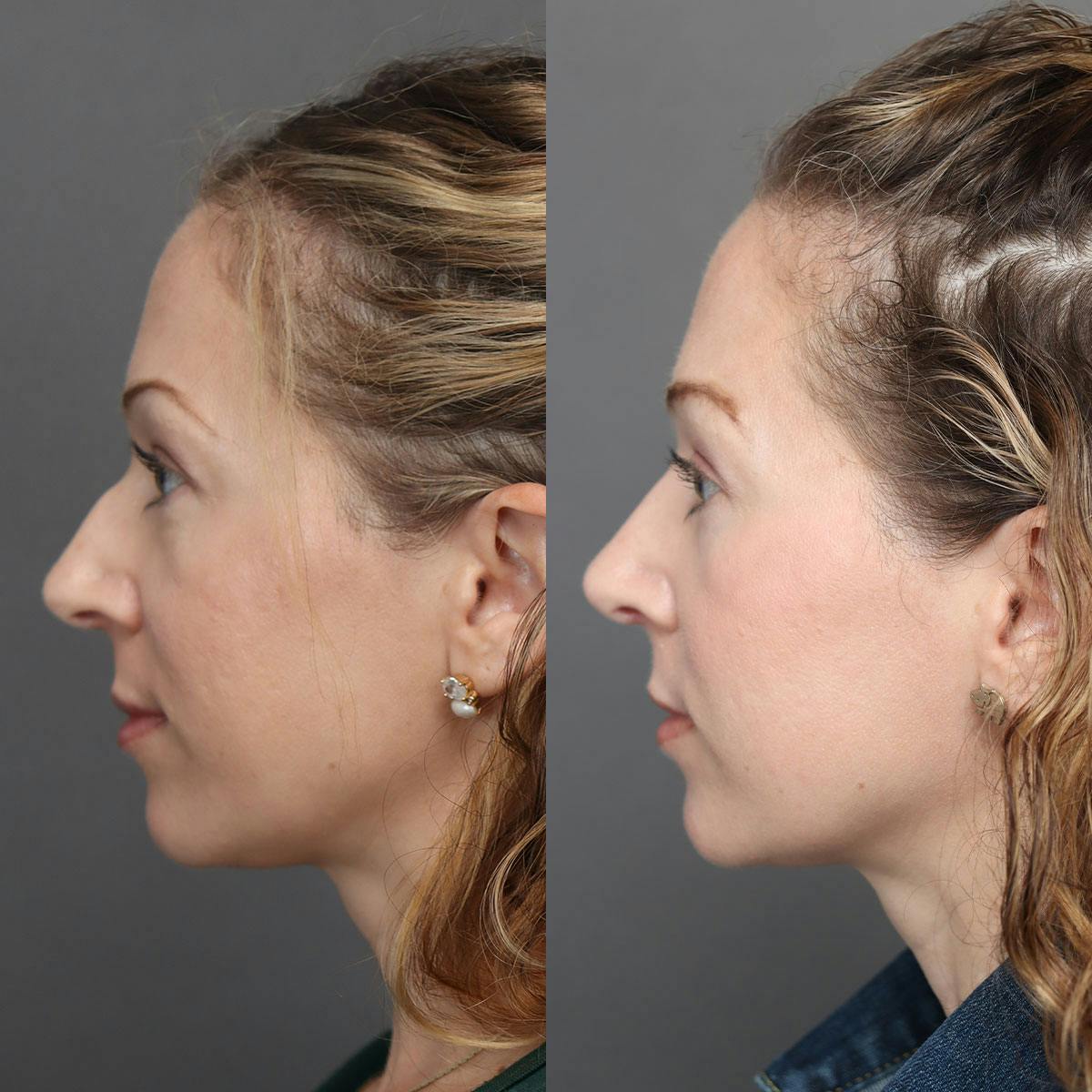 Rhinoplasty Before & After Gallery - Patient 322343 - Image 5