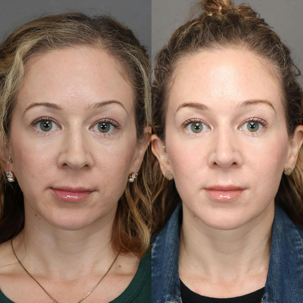 Rhinoplasty Before & After Gallery - Patient 322343 - Image 3