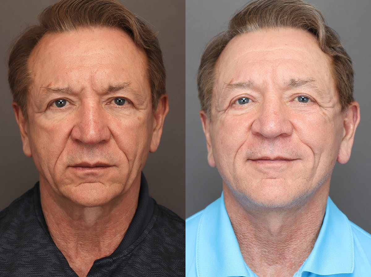 Facelifts Before & After Gallery - Patient 117767 - Image 1