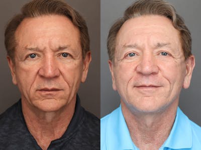 Facelifts Before & After Gallery - Patient 117767 - Image 1