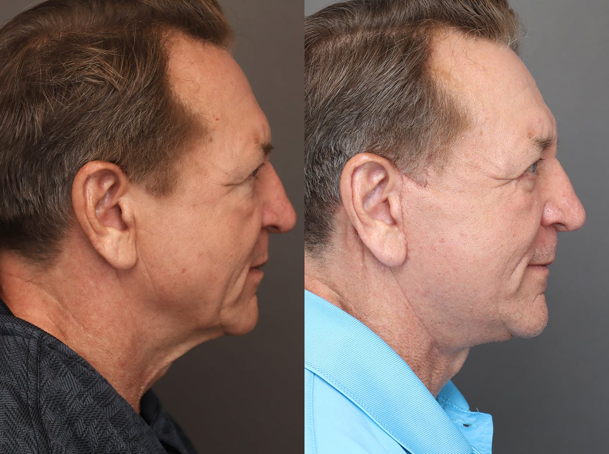 Facelifts Before & After Gallery - Patient 117767 - Image 2