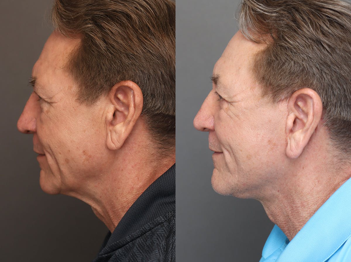Facelifts Before & After Gallery - Patient 117767 - Image 3