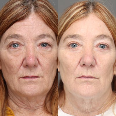 Eyelifts & Blepharoplasty Before & After Gallery - Patient 860908 - Image 1