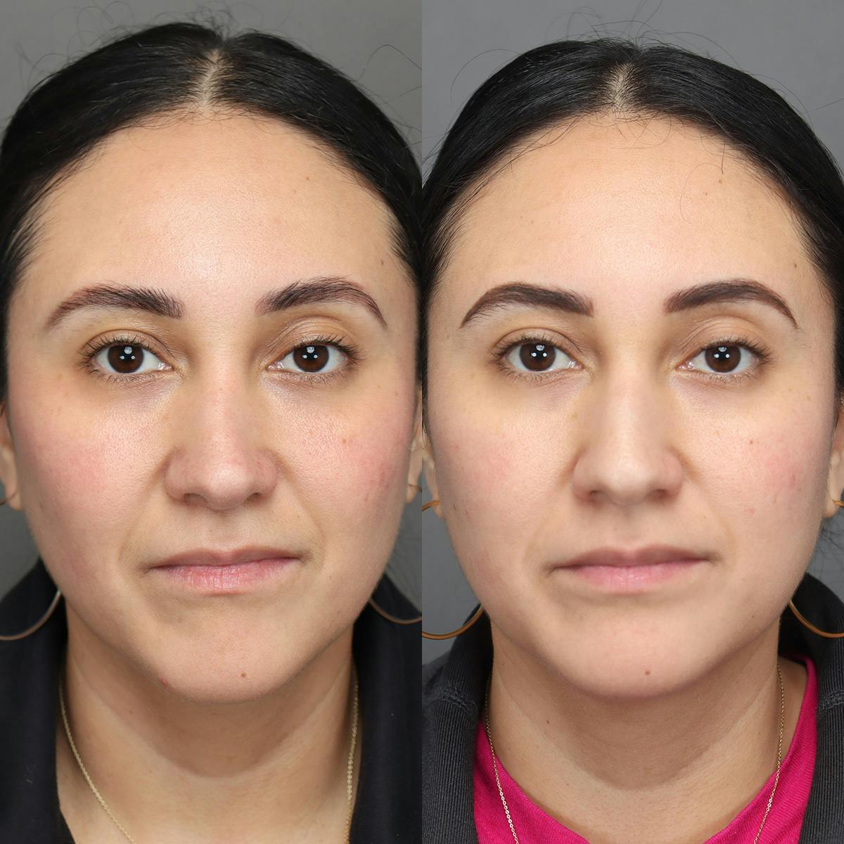 Rhinoplasty Before & After Gallery - Patient 398639 - Image 3