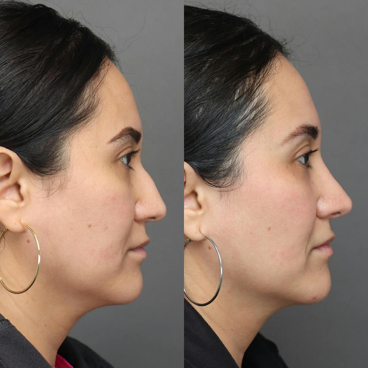 Rhinoplasty Before & After Gallery - Patient 398639 - Image 1