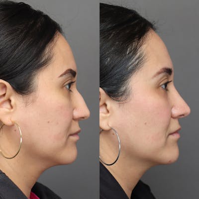 Rhinoplasty Before & After Gallery - Patient 398639 - Image 1