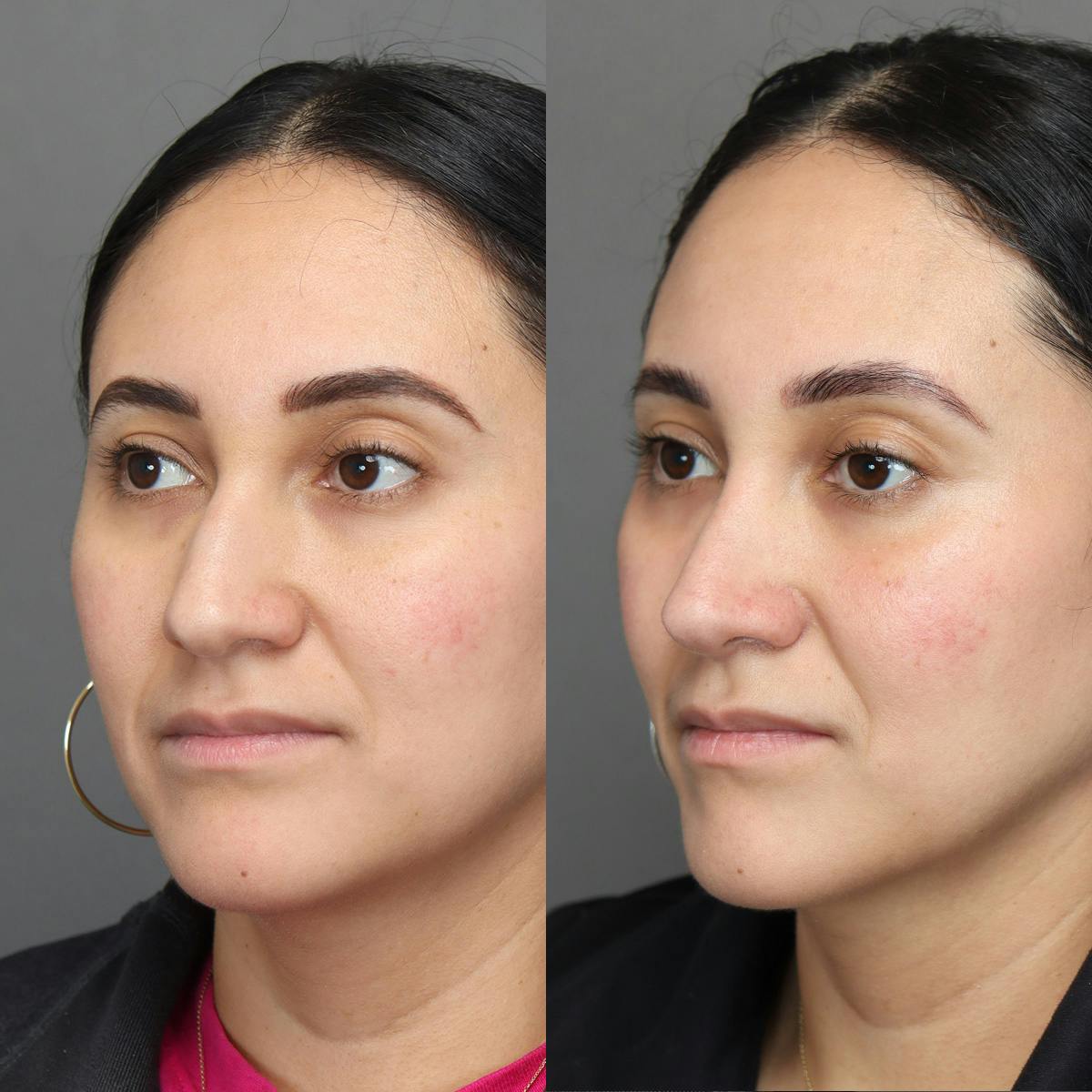 Rhinoplasty Before & After Gallery - Patient 398639 - Image 4