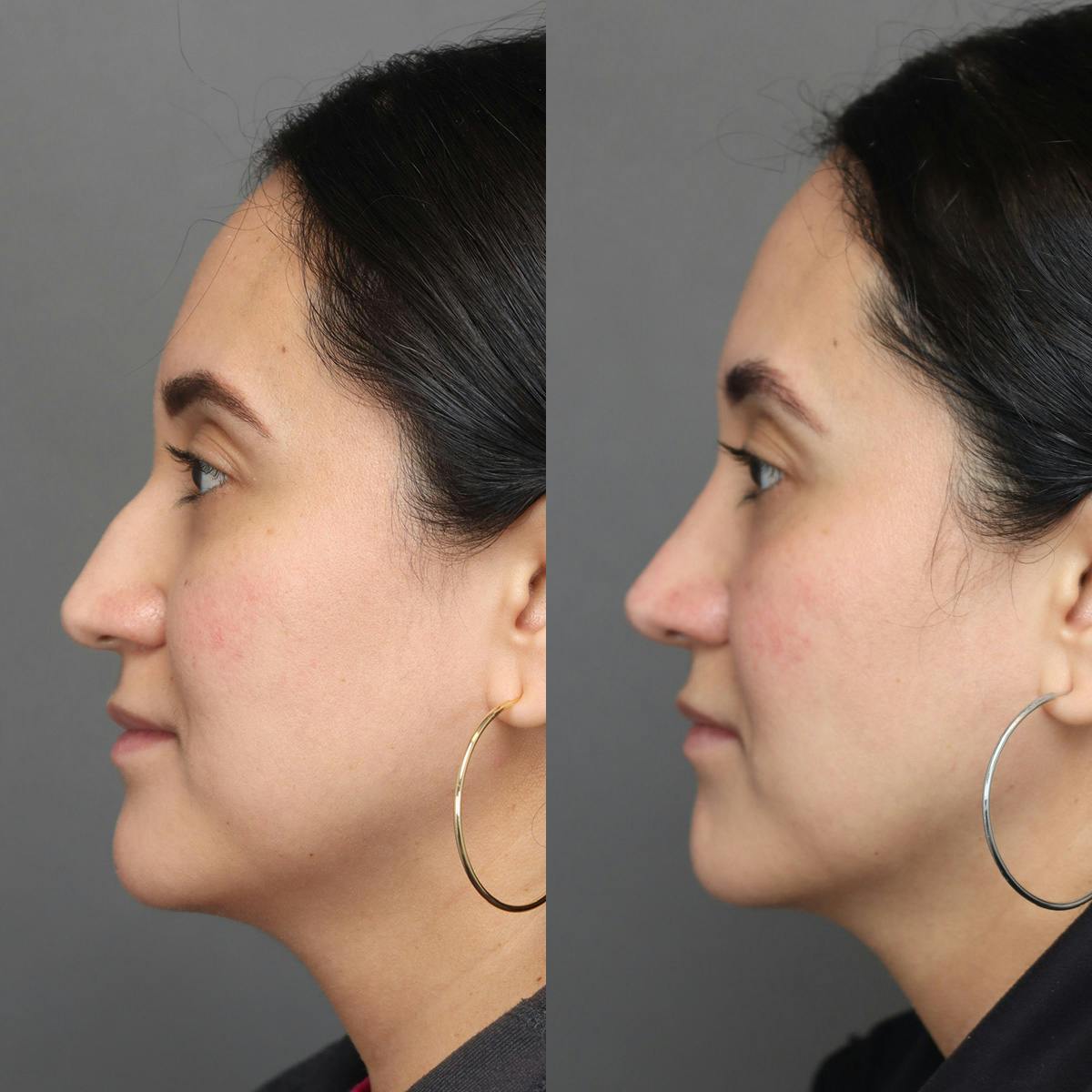 Rhinoplasty Before & After Gallery - Patient 398639 - Image 5