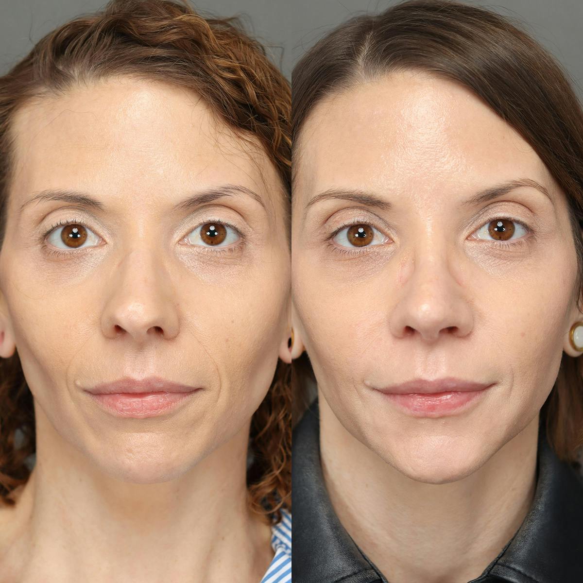 Rhinoplasty Before & After Gallery - Patient 583868 - Image 2